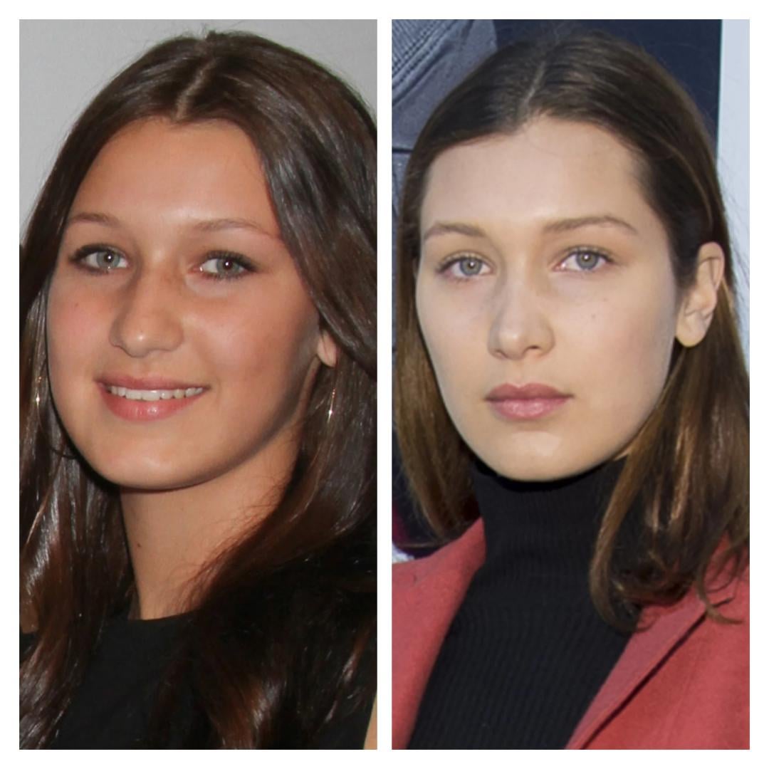 Bella Hadid Before and After Surgery: You Wont Believe How Much Shes Changed!