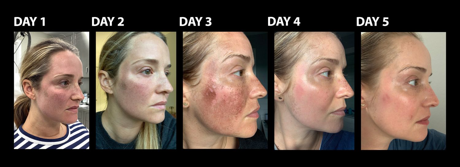 Thinking about Fraxel treatment? See real Fraxel before and after pictures to know what results expect.