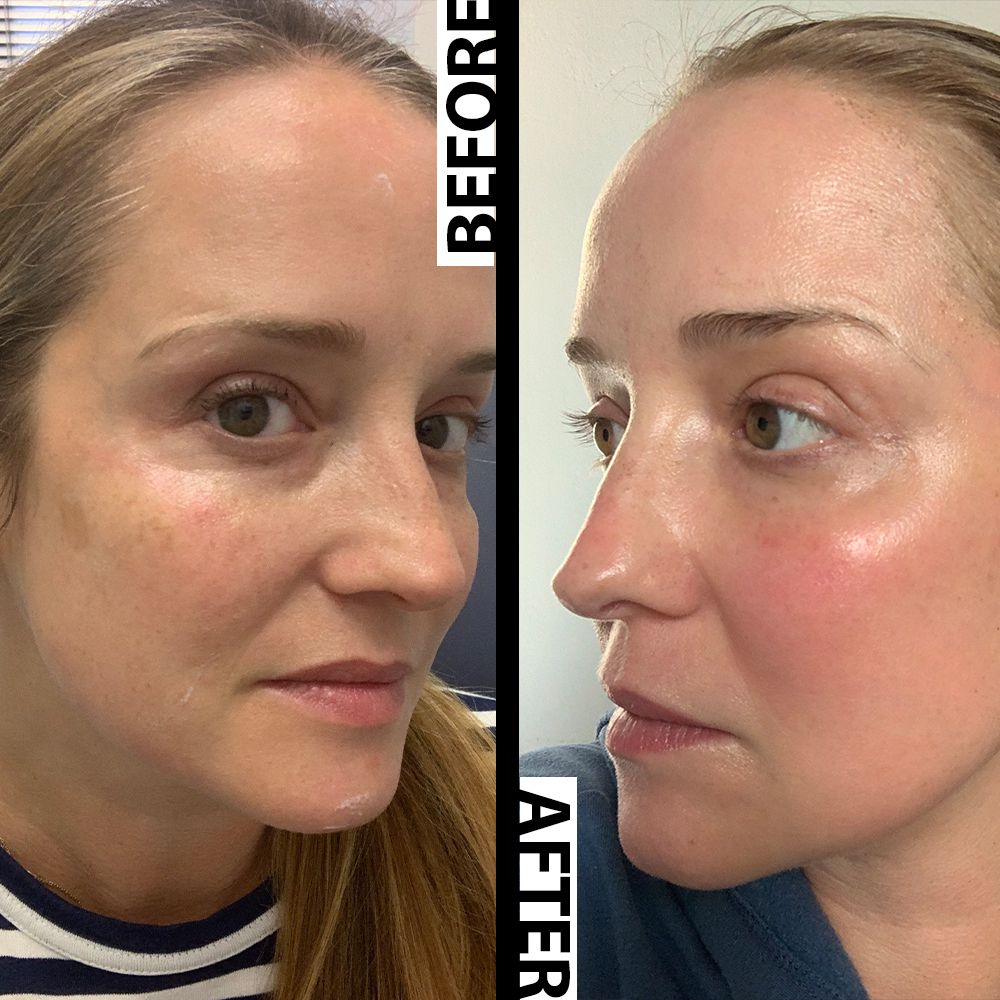 Thinking about Fraxel treatment? See real Fraxel before and after pictures to know what results expect.