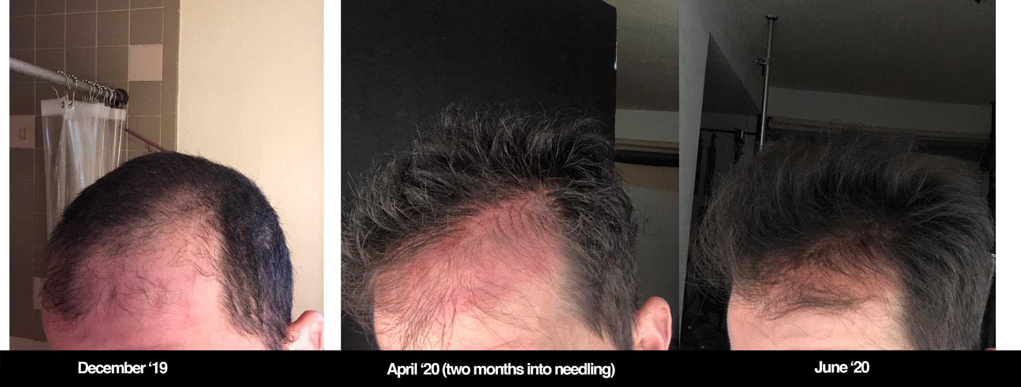 Whats the big deal with reddit microneedling hair? Everything you absolutely need to know from forums.