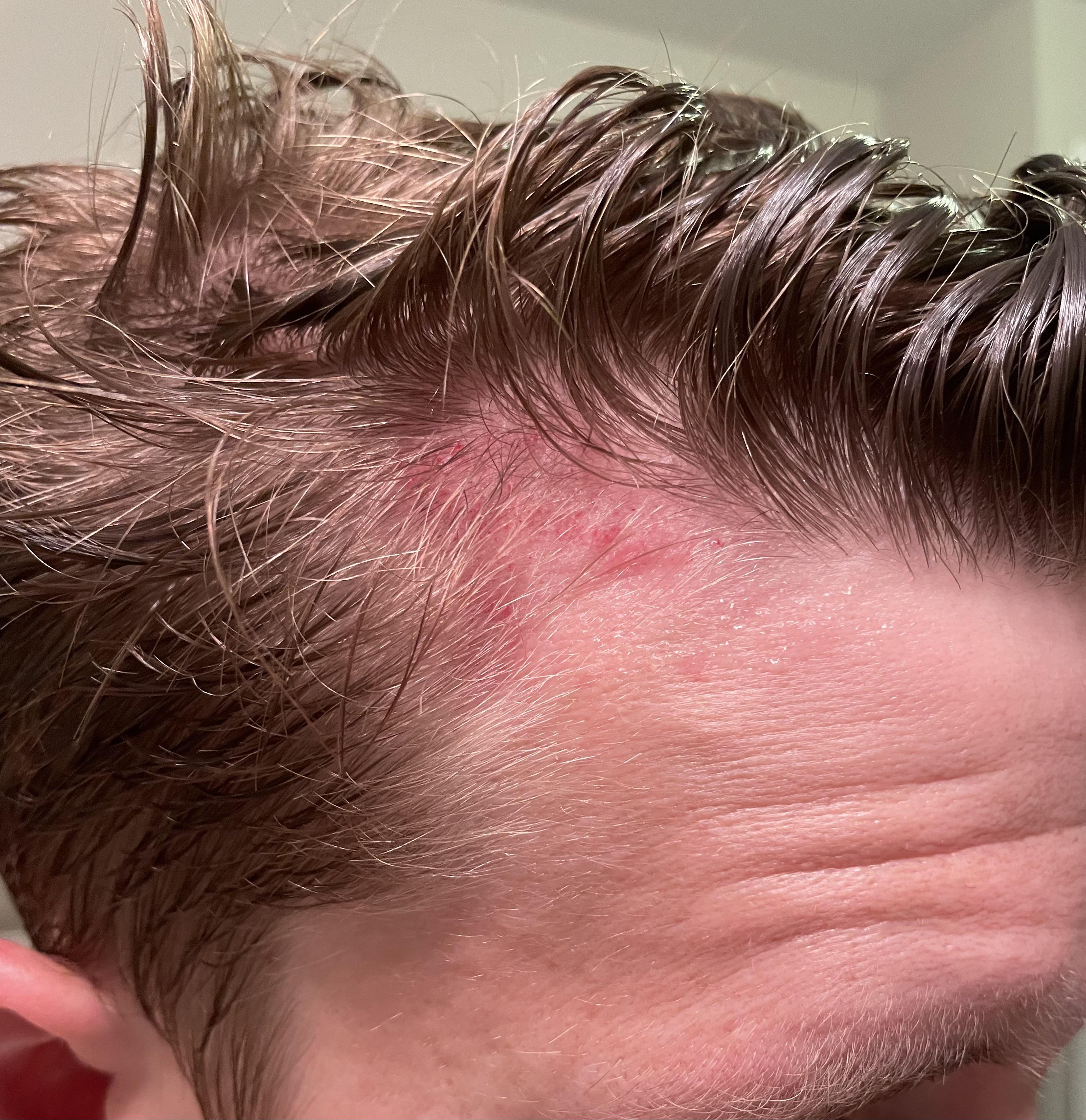 Whats the big deal with reddit microneedling hair? Everything you absolutely need to know from forums.