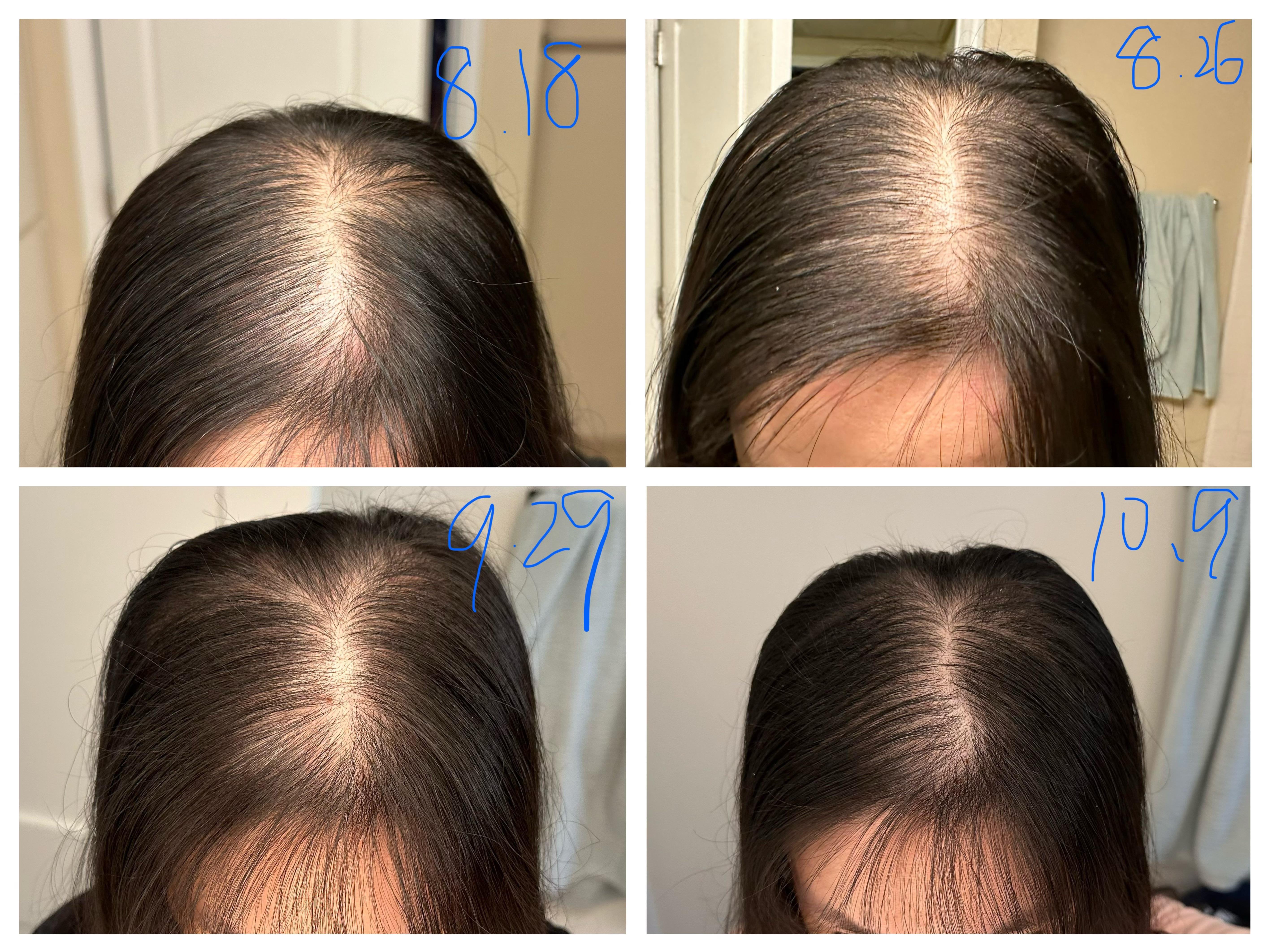 Whats the big deal with reddit microneedling hair? Everything you absolutely need to know from forums.
